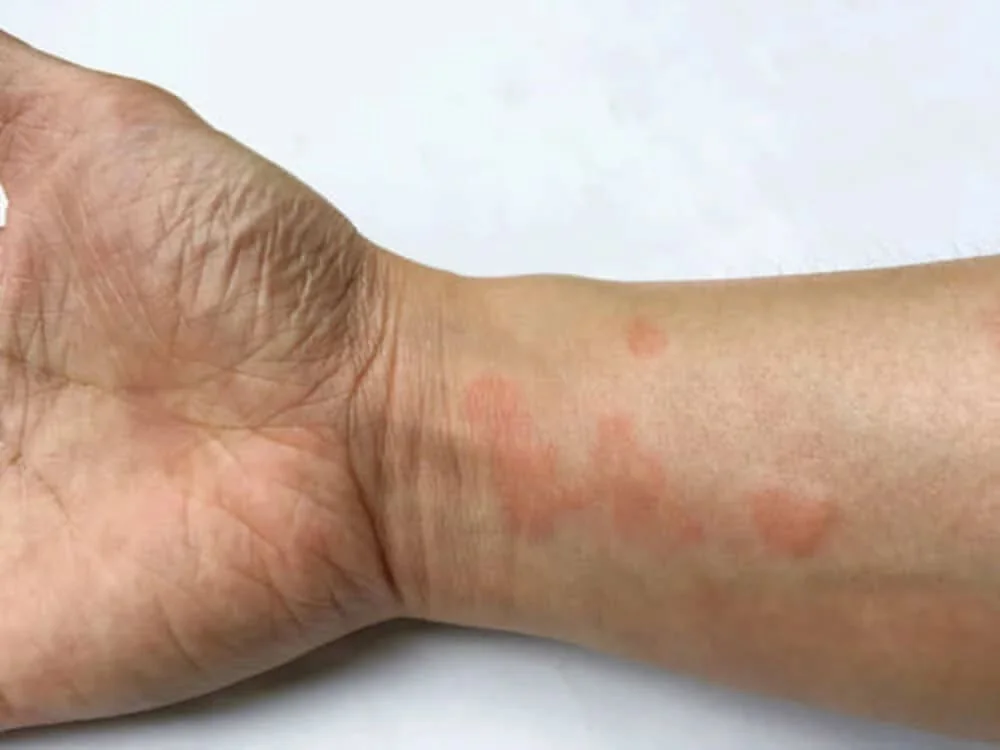 Diagnostic lupus Diagnostic lupus