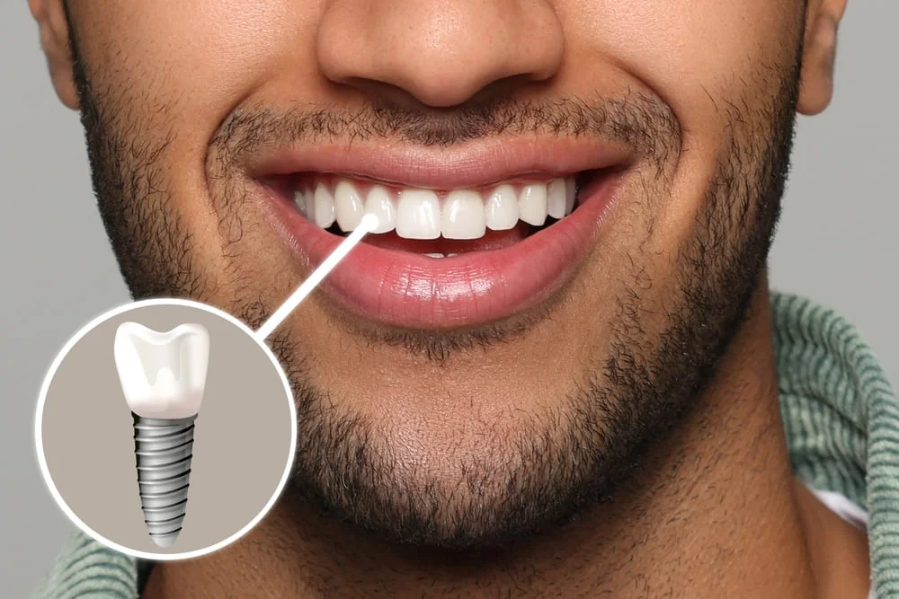 Implant zigomatic: in ce consta, indicatii si contraindicatii