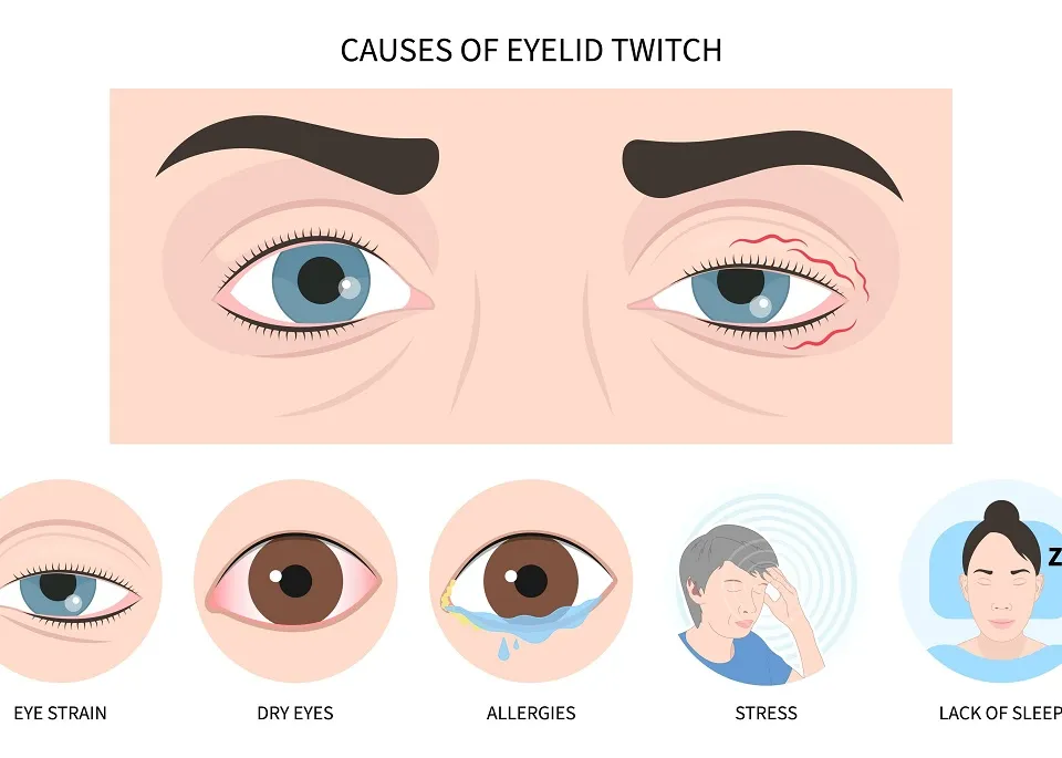 Zbaterea ochiului - cauze