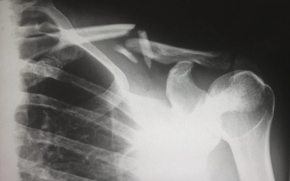 Radiografie fractura Radiografie fractura