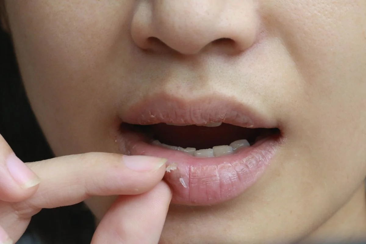 Cheilita exfoliativa: cauze, simptome, tratament