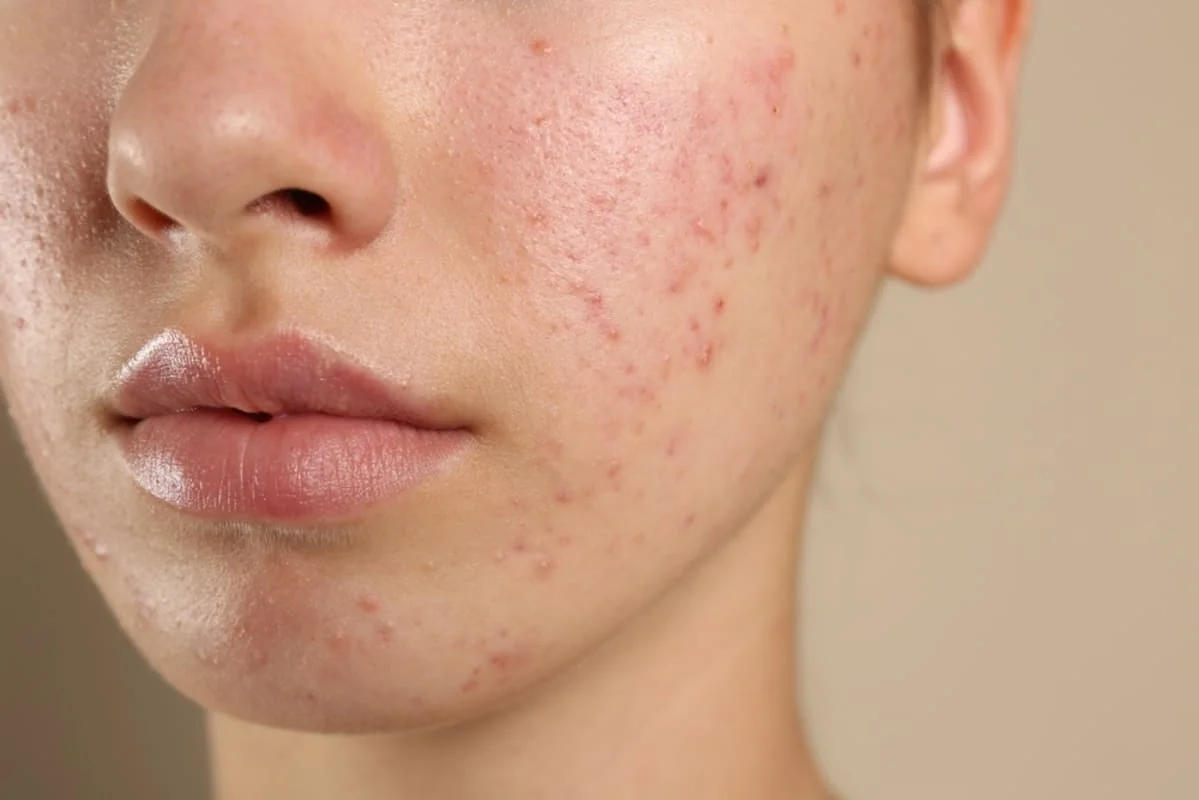 Semne post-acneice vs. cicatrici: cum le deosebesti?