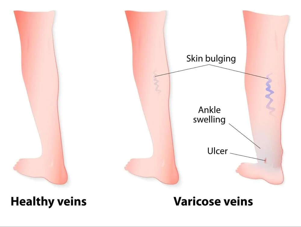 Simptome asociate ulcerului varicos Simptome asociate ulcerului varicos