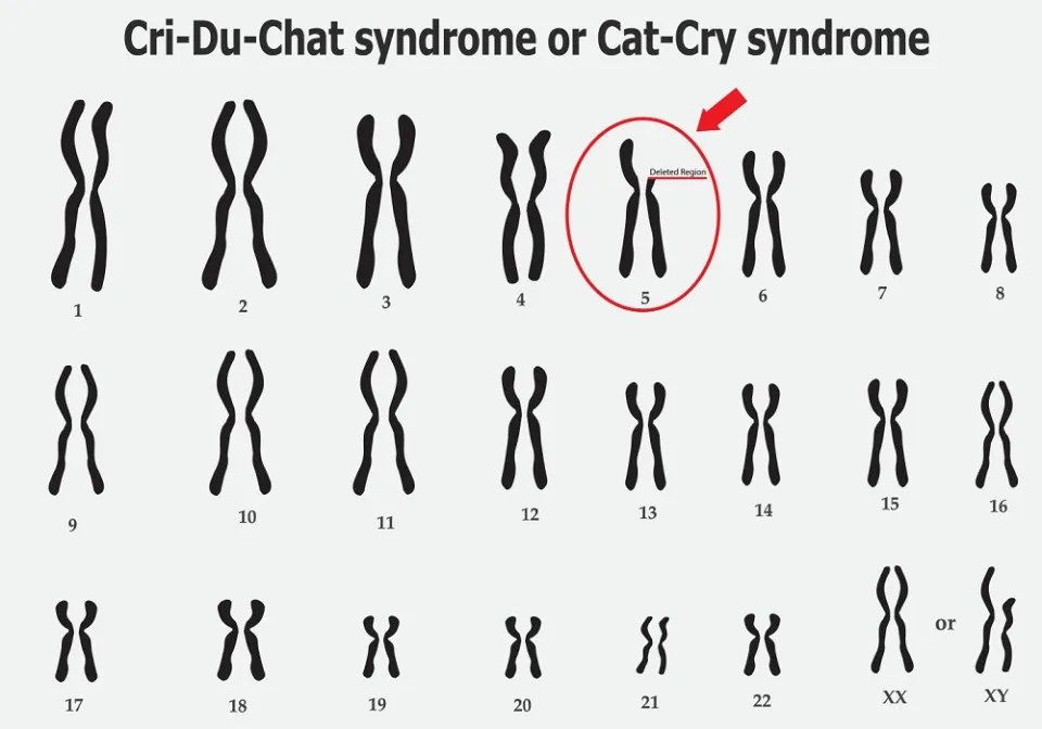 Sindromul Cri du chat