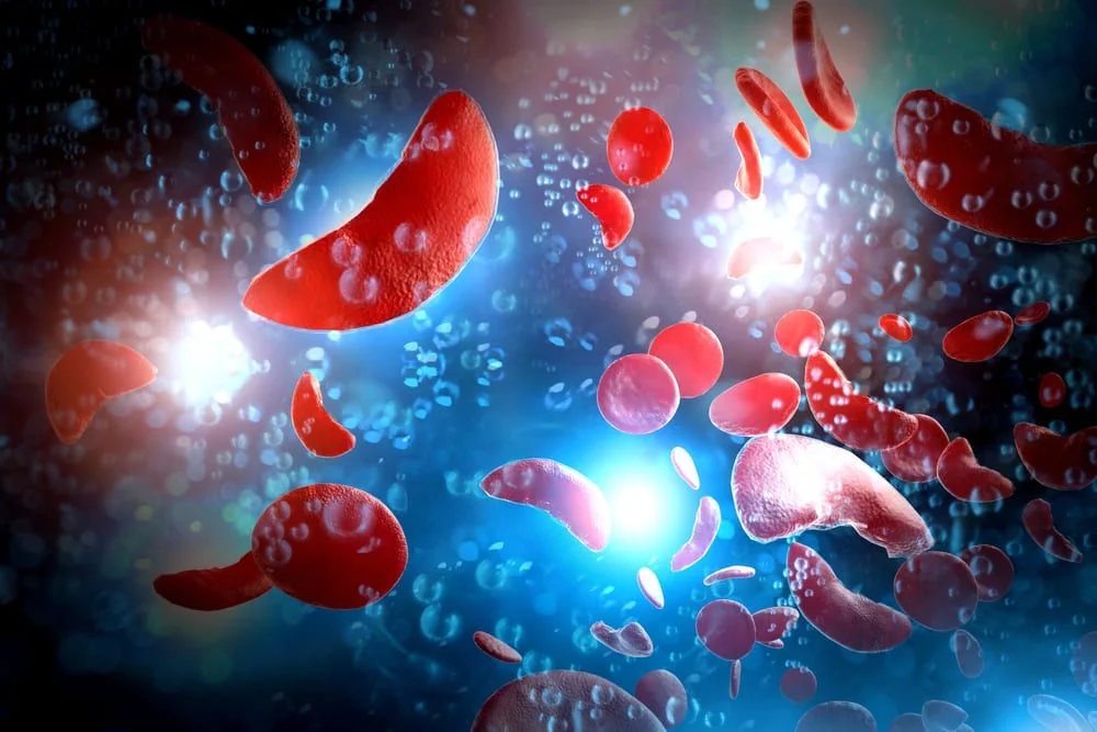 Anemia pernicioasa (anemia Biermer): cauze, simptome, tratament