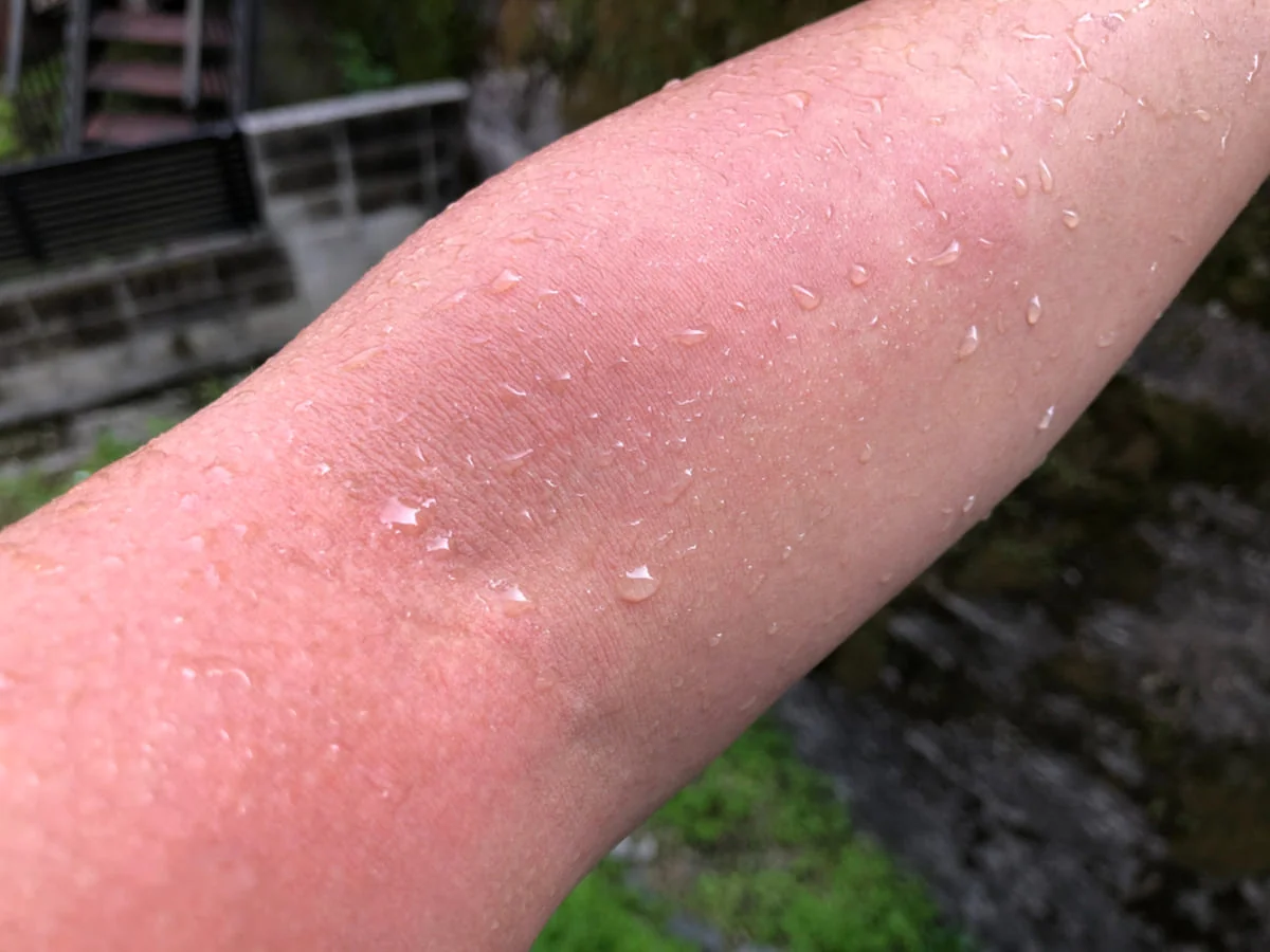 Urticaria acvagena: ce este alergia la apa, simptome si diagnostic