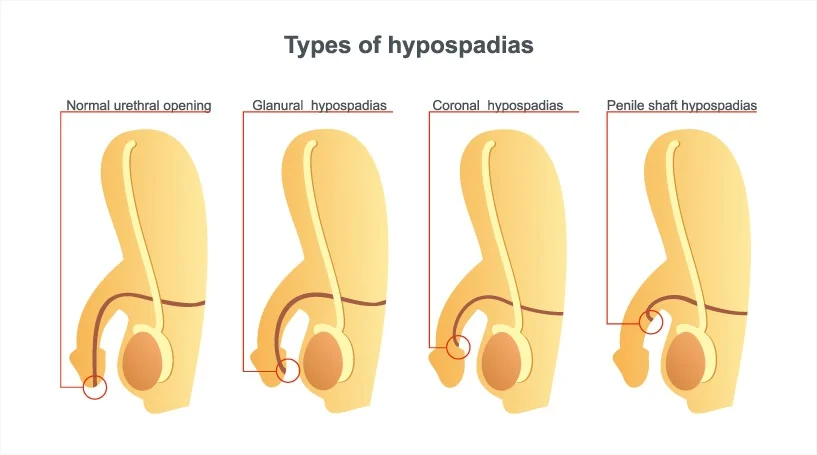 Types hypospadias Types hypospadias