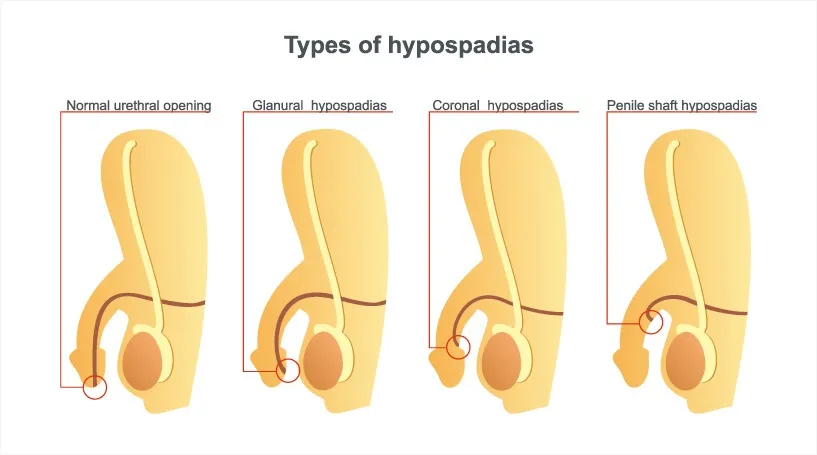 Types hypospadias