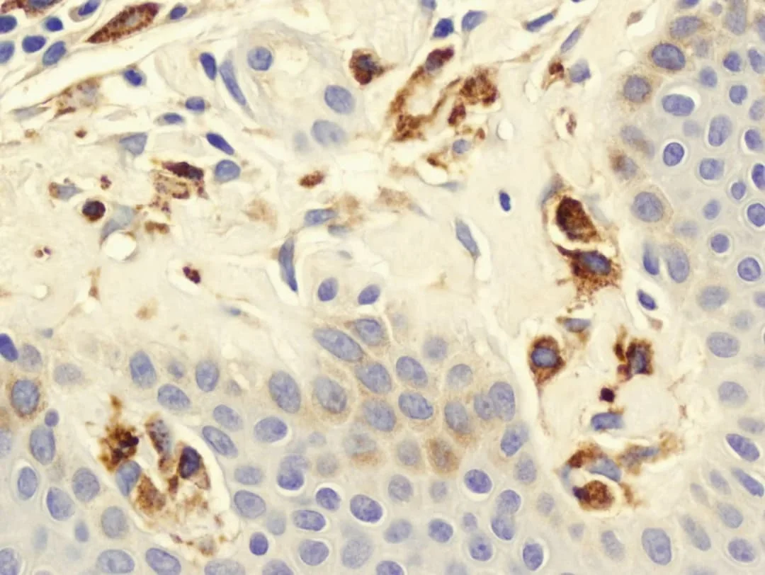 Diagnostic mastocitoza Diagnostic mastocitoza