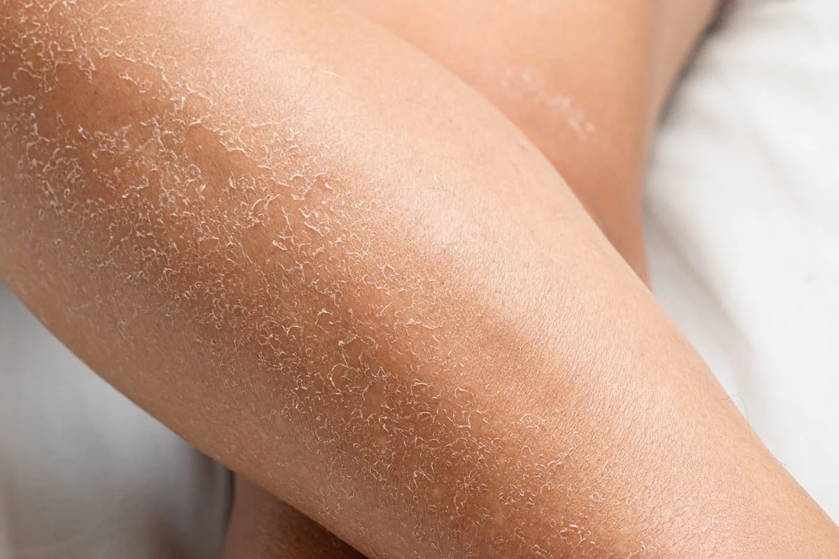 dermatita exfoliativa pe brate