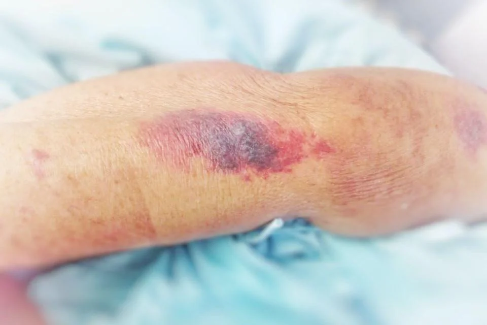 Escare: ce inseamna, cauze, simptome, tratament, preventie