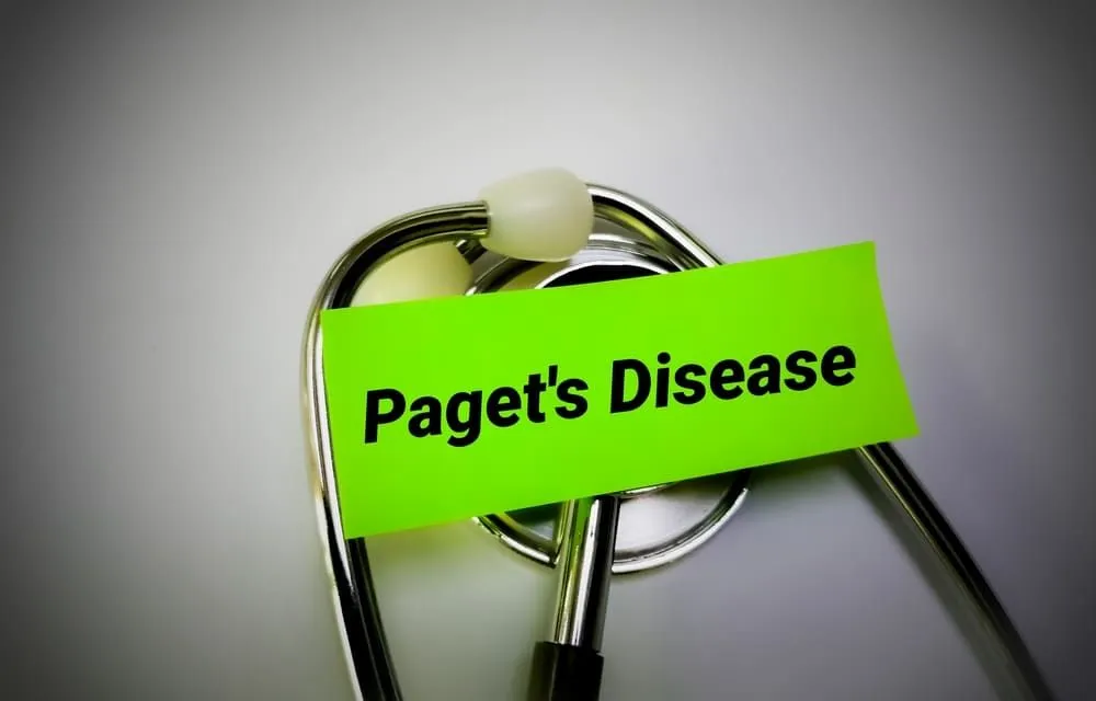 Boala Paget: cauze, simptome, tratament