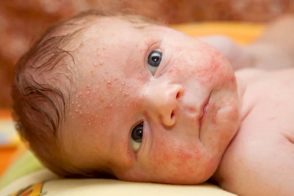 Afla ce este acneea bebelusului, cum si cand se manifesta, de ce apare si la ce metode de ingrijire si tratament poti apela! Citeste acum articolul!