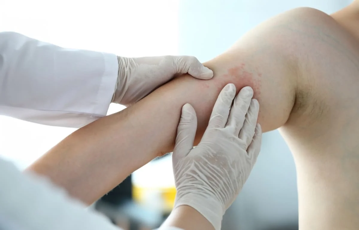 Urticaria acvagena: ce este alergia la apa si cum influenteaza viata?