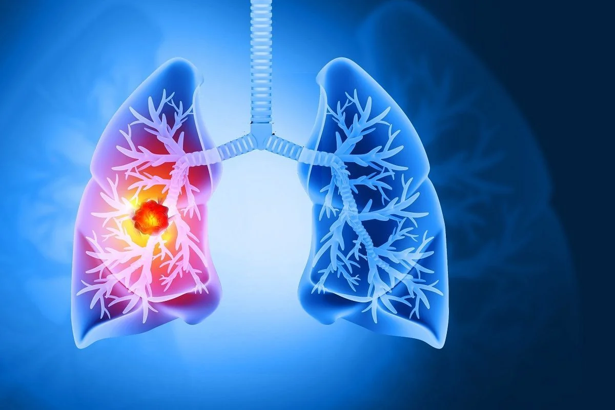 Cancer pulmonar: cauze, simptome, tratament