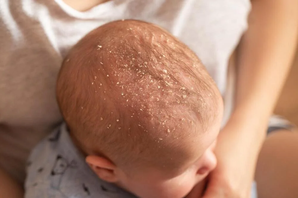 Dermatita seboreica la copii Dermatita seboreica la copii