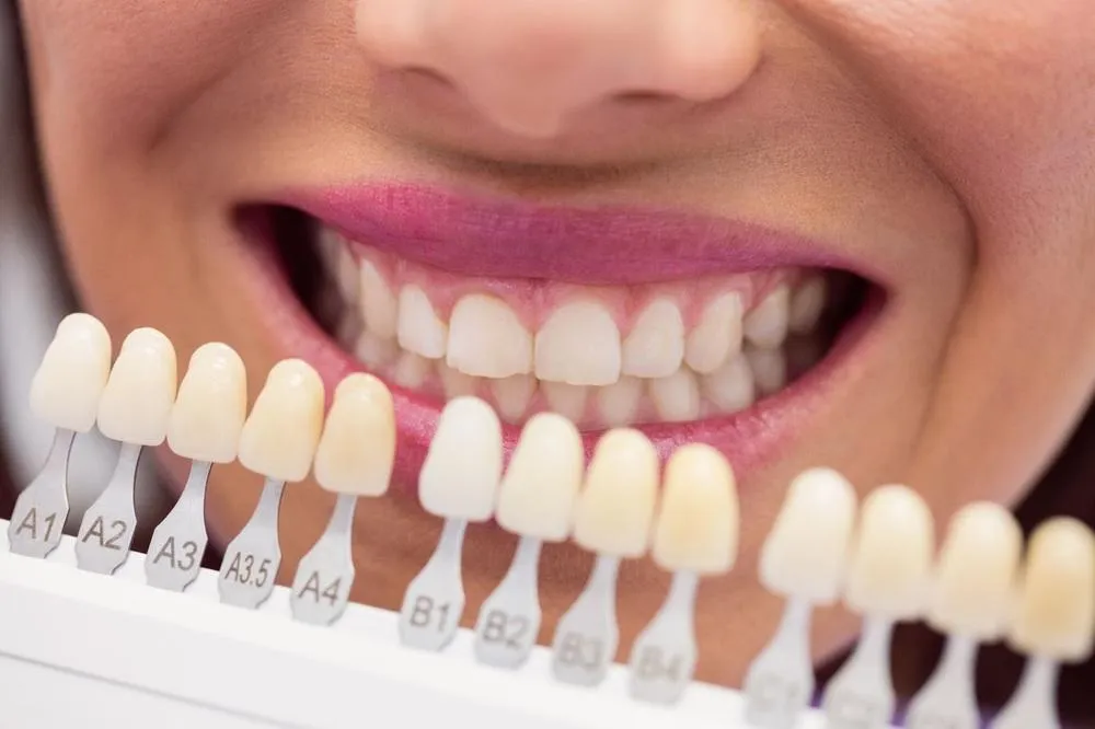 Fatete dentare: tipuri, indicatii, avantaje, dezavantaje